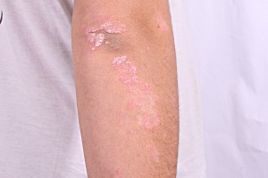 Alternative Treatment and Self Care for Psoriasis
