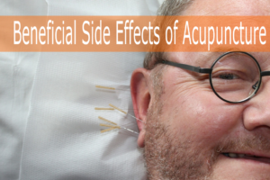 Beneficial Side Effects of Acupuncture